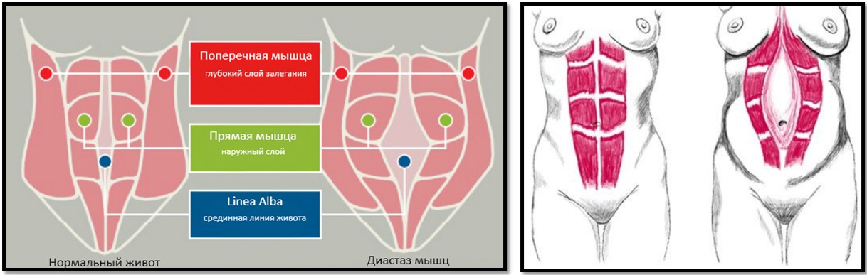 Диастаз прямых мышц живота анатомия