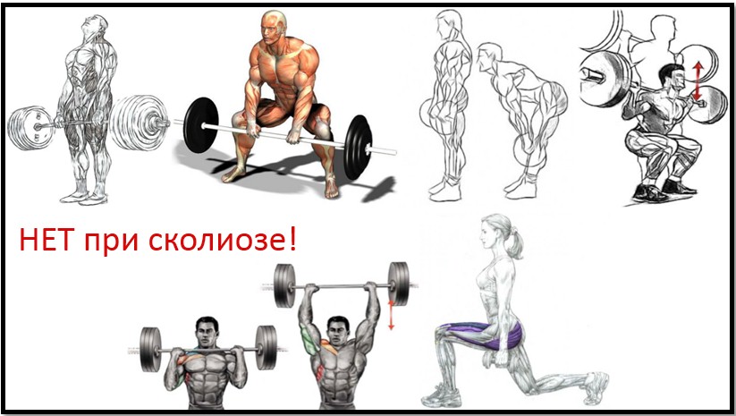 Самые эффективные упражнения от сколиоза для подростков