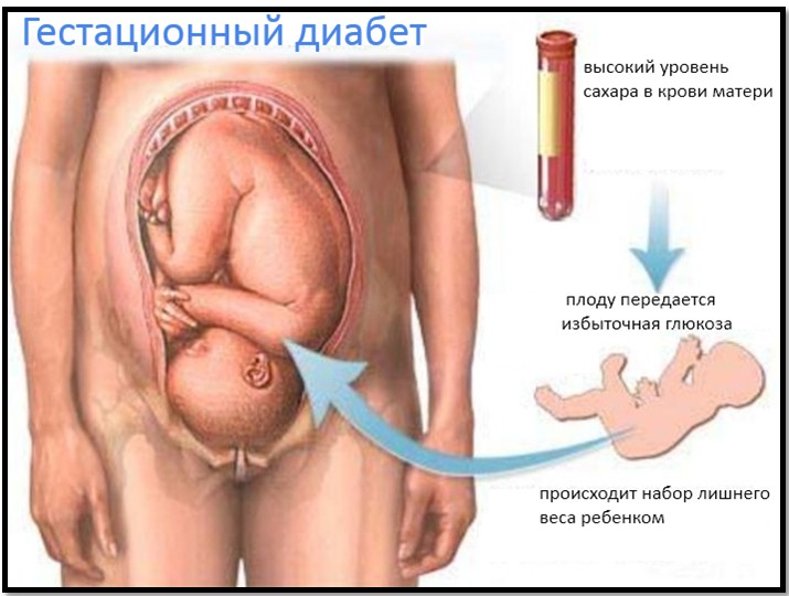 полая вена при беременности 
